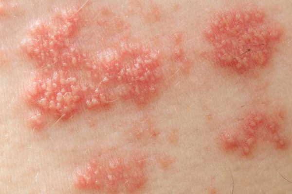 Mencegah Shingles, Langkah-Langkah untuk Lindungi Diri dari Herpes Zoster